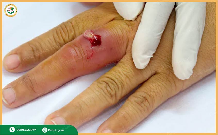 cách xử lý nhiễm trùng tại nhà