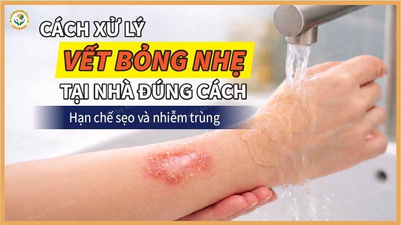 cách xử lý vết bỏng nhẹ tại nhà đúng cách