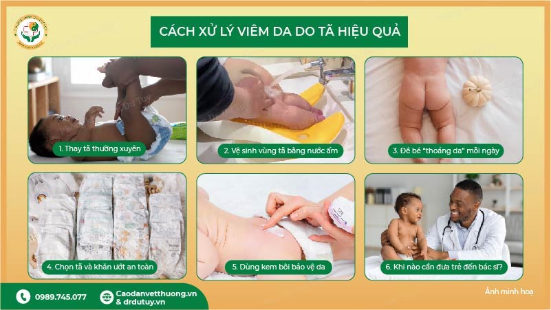 cách xử lý viêm da do tã ở trẻ hiệu quả