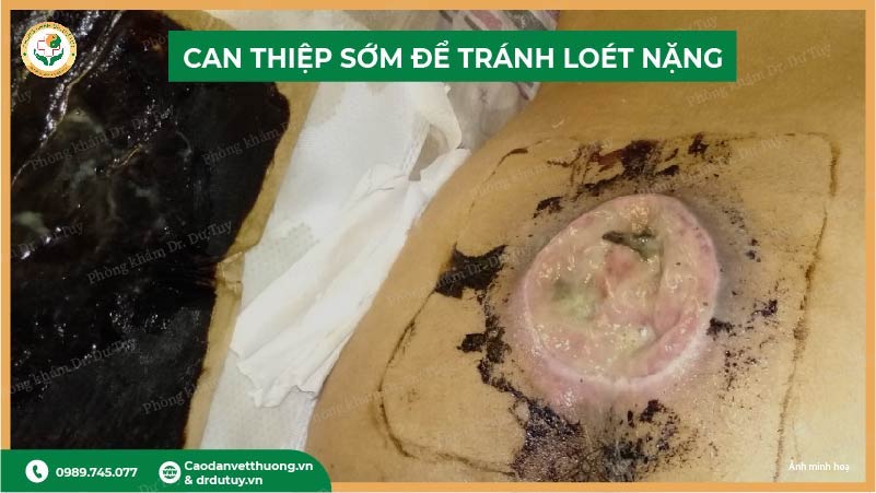 can thiệp sớm để tránh loét cùng cụt nặng