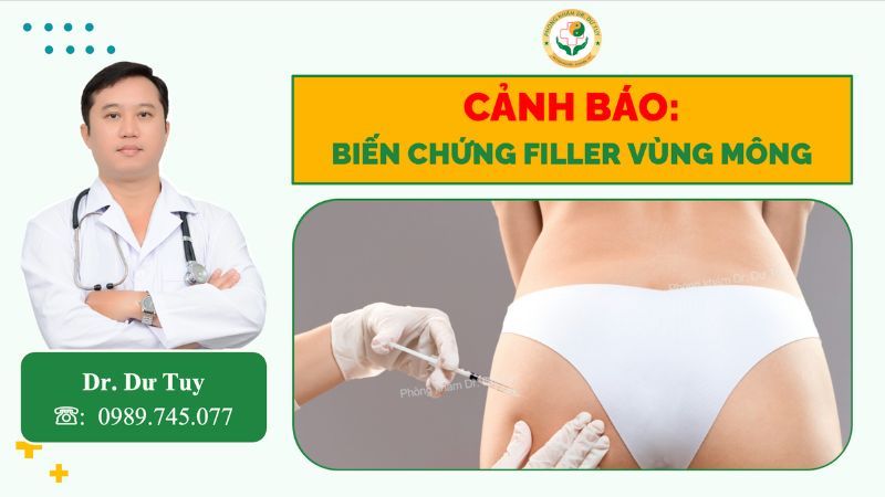 cảnh báo biến chứng filler vùng mông