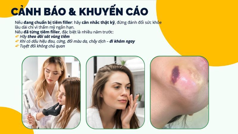 cảnh báo khuyến cáo tiêm filler