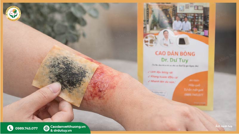 cao dán bỏng hỗ trợ chăm sóc vết thương