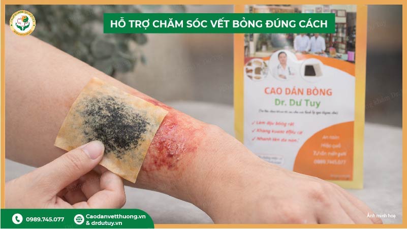 cao dán bỏng hỗ trợ phục hồi