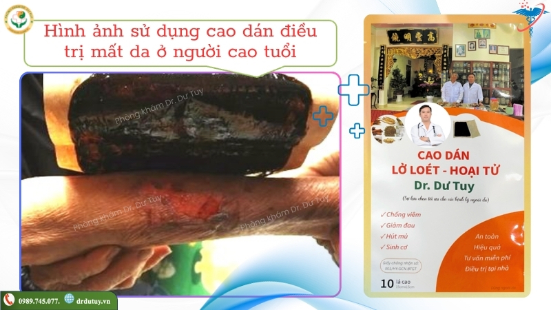 cao dán chăm sóc vết thương mất da