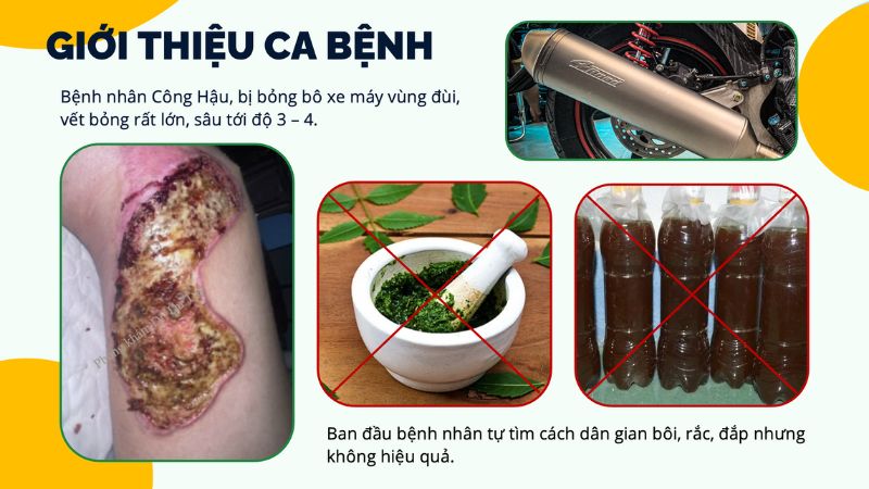 cao dán chữa bỏng