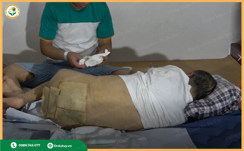 cao dán chữa loét cùng cụt