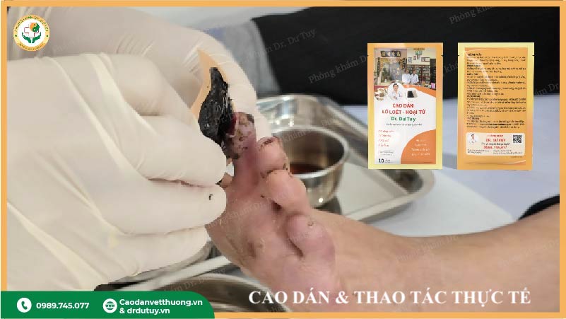 cao dán Dr. Dư Tuy điều trị hoại tử ngoài da