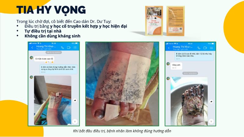 cao dán Dr. Dư Tuy điều trị vết thương bàn chân