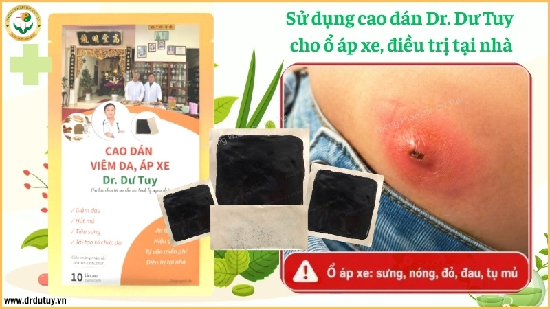 cao dán Dr. Dư Tuy hỗ trợ áp xe ngoài da