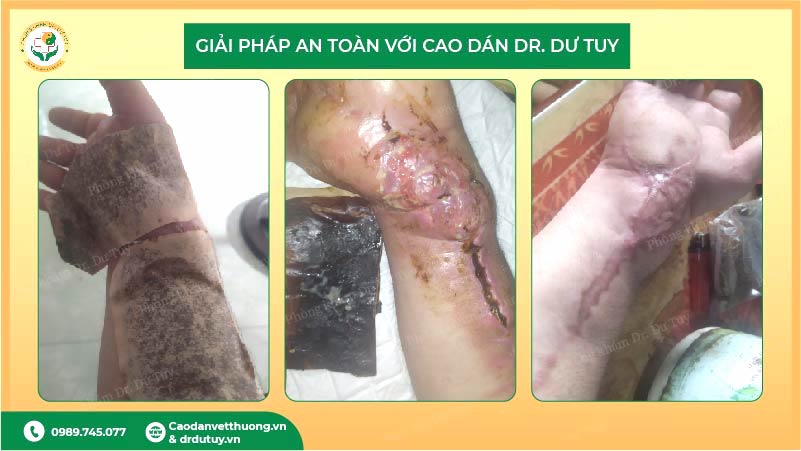 cao dán dr dư tuy hỗ trợ giảm khó chịu vùng mổ