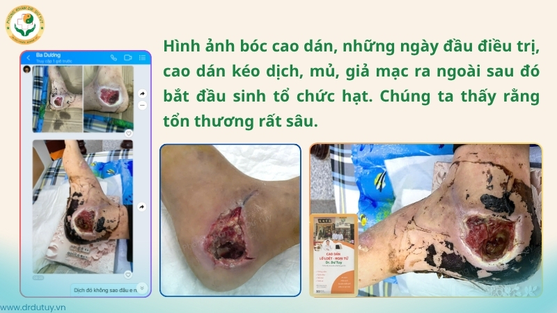 cao dán kéo dịch mủ giả mạc vết thương gót chân