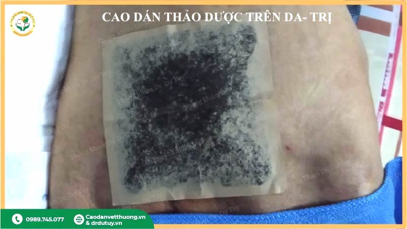 cao dán thảo dược điều trị lở loét tại nhà