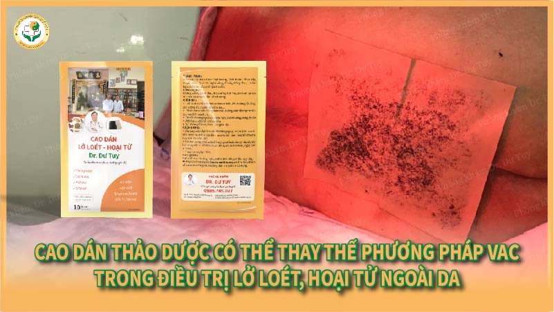 Cao dán thảo dược có thể thay thế phương pháp VAC trong điều trị lở loét, hoại tử ngoài da