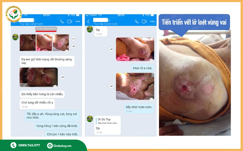 Cao dán trị lở loét Dr. Dư Tuy