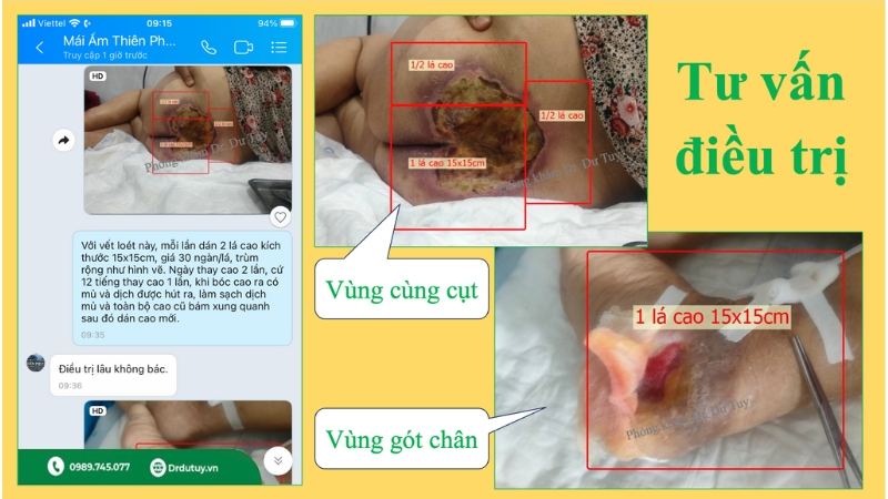 cao dán trị loét da