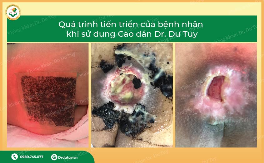 cao dán trị loét tỳ đè