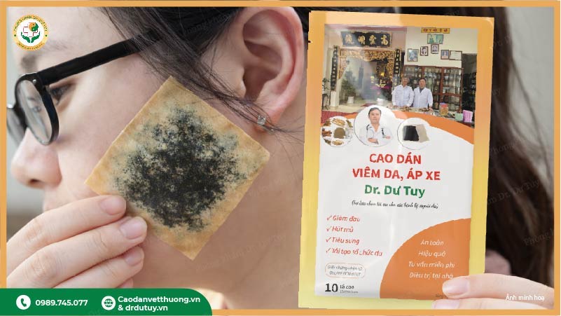 cao dán viêm da áp xe Dr. Dư Tuy