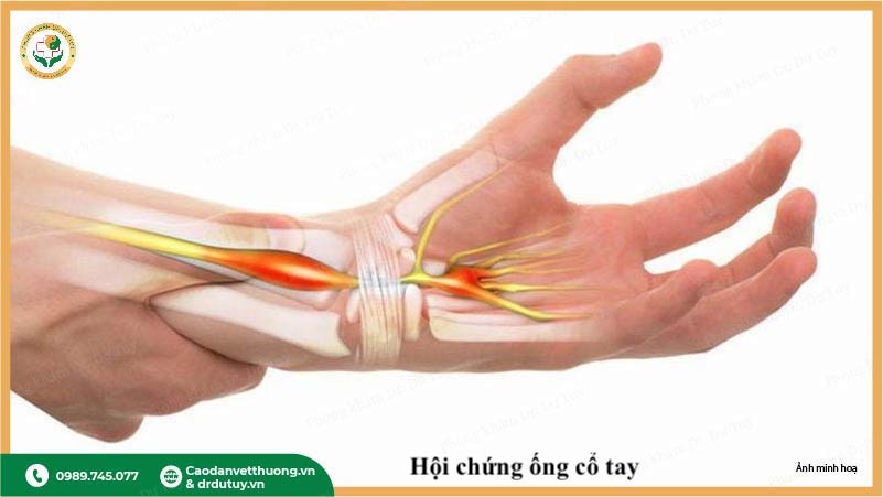 carpal tunnel syndrome dây thần kinh giữa