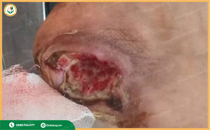 cắt cụt chân co tiểu đường