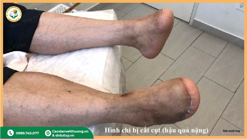 cắt cụt chi do hoại tử hậu quả chậm điều trị
