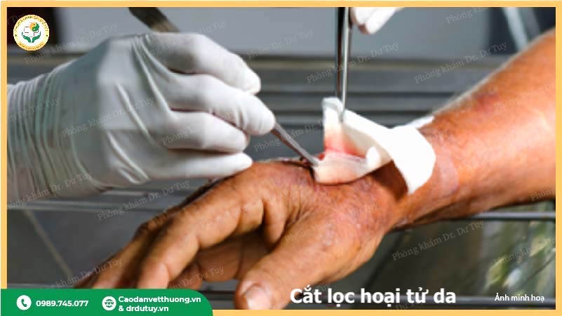 cắt lọc hoại tử da bàn tay chăm sóc vết thương