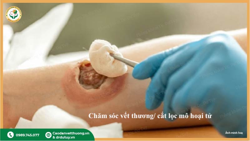 cắt lọc mô hoại tử điều trị vết thương