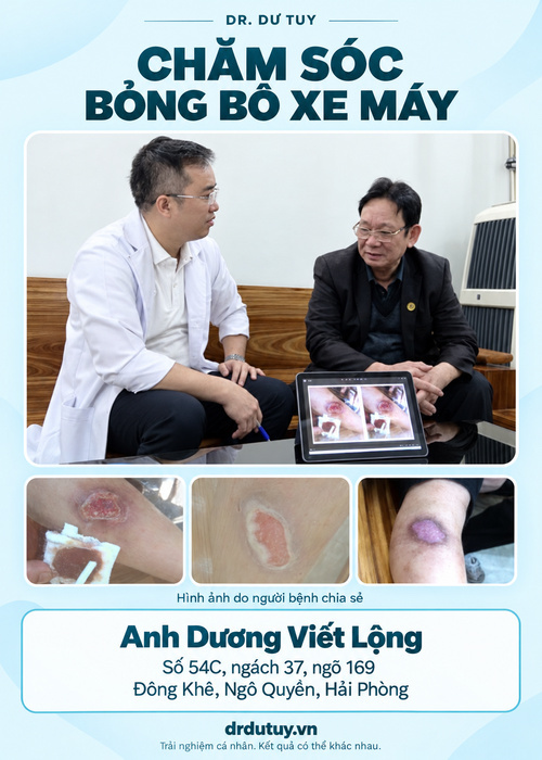 Bỏng bô xe máy