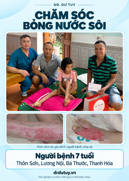 Bỏng nước sôi ở trẻ nhỏ