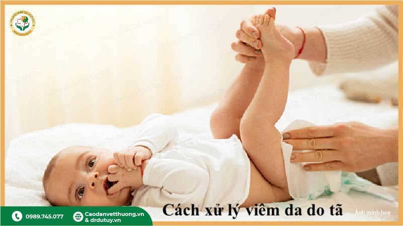 chăm sóc da vùng tã cho bé phòng hăm da