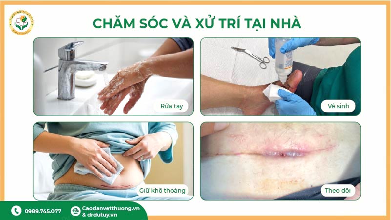 chăm sóc nhiễm trùng vết mổ tại nhà