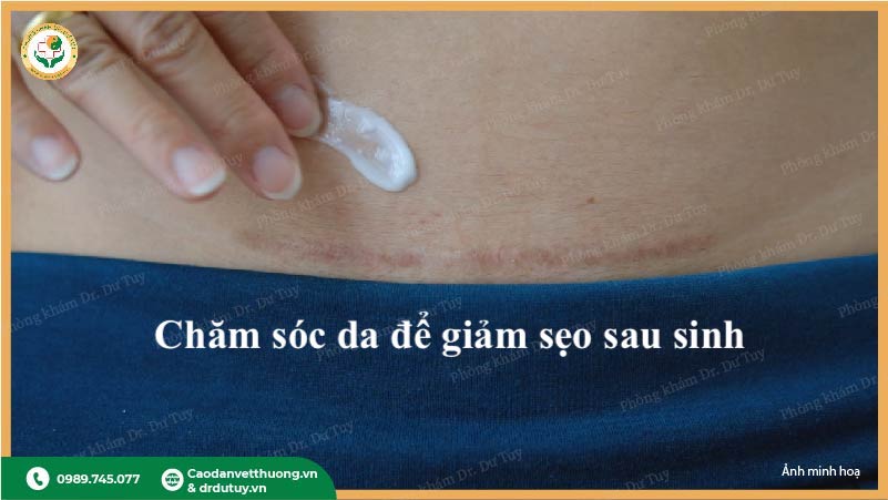 chăm sóc sản phụ sau sinh mổ