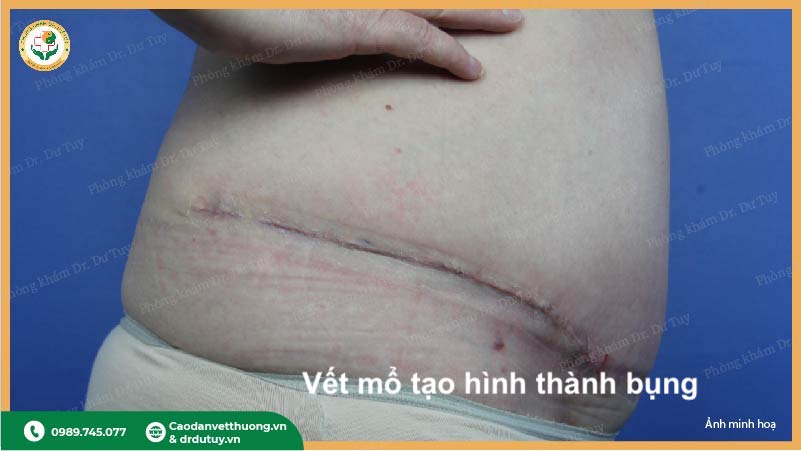 chăm sóc sau phẫu thuật thẩm mỹ bụng