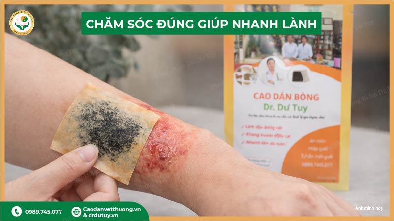 chăm sóc vết bỏng nhanh lành