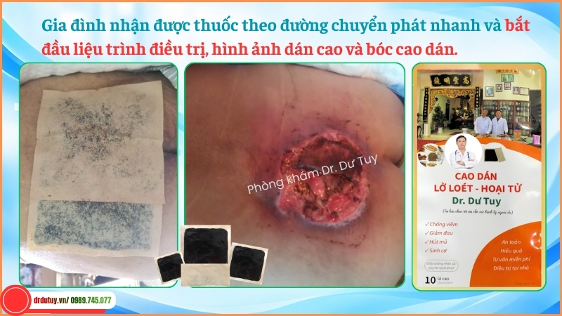 chăm sóc vết loét cùng cụt bằng cao dán