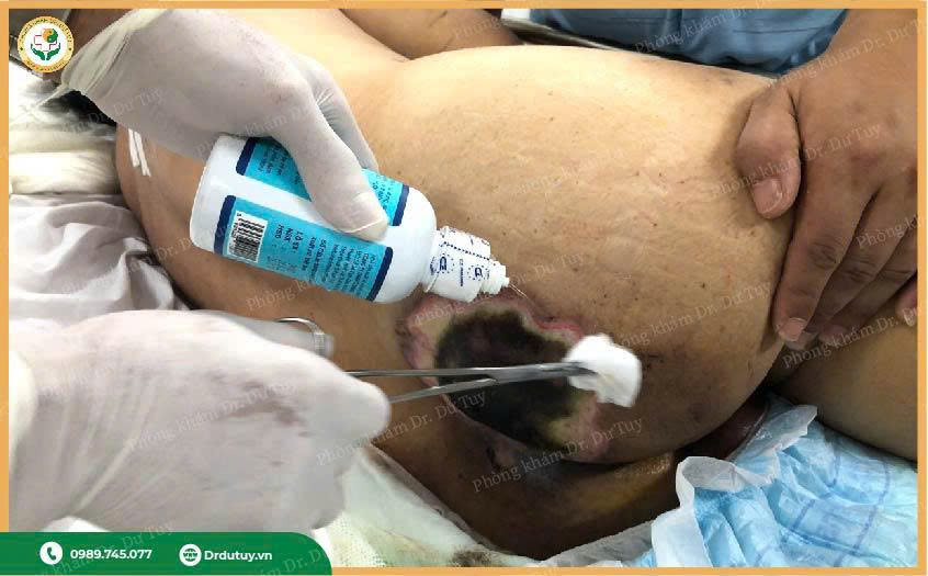 chăm sóc vết loét do nằm lâu