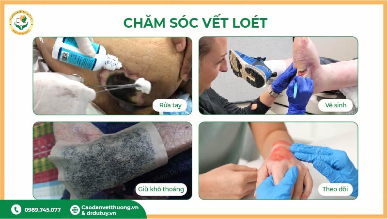 chăm sóc vết loét đúng cách y khoa
