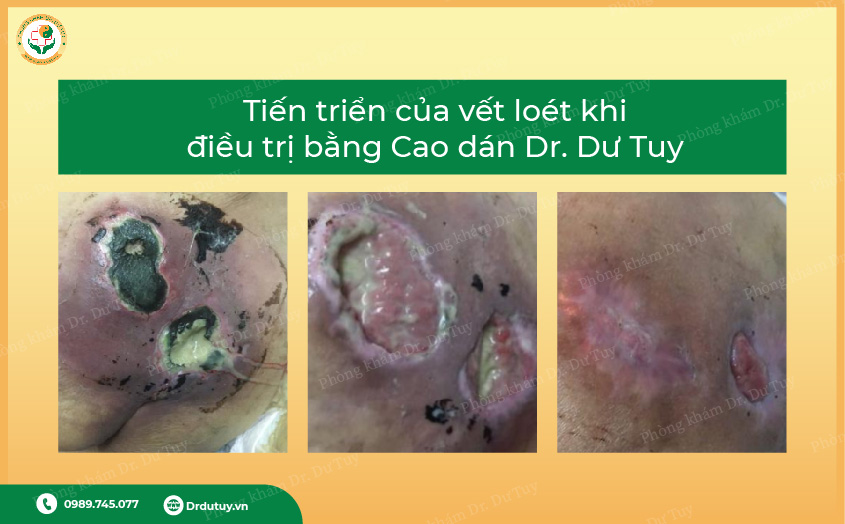 chăm sóc vết loét người già