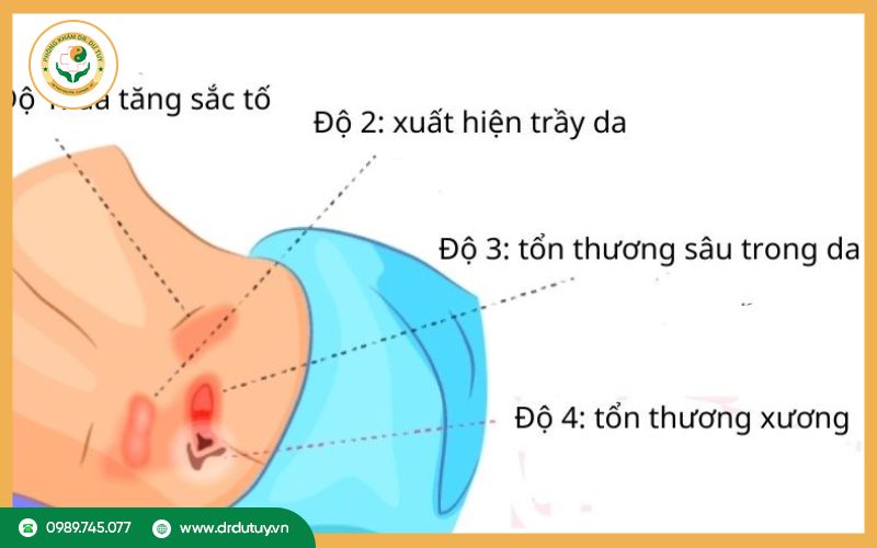 Loét tì đè là gì? Các mức độ loét tì đè