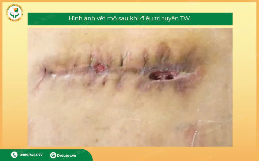 chăm sóc vết mổ sau phẫu thuật