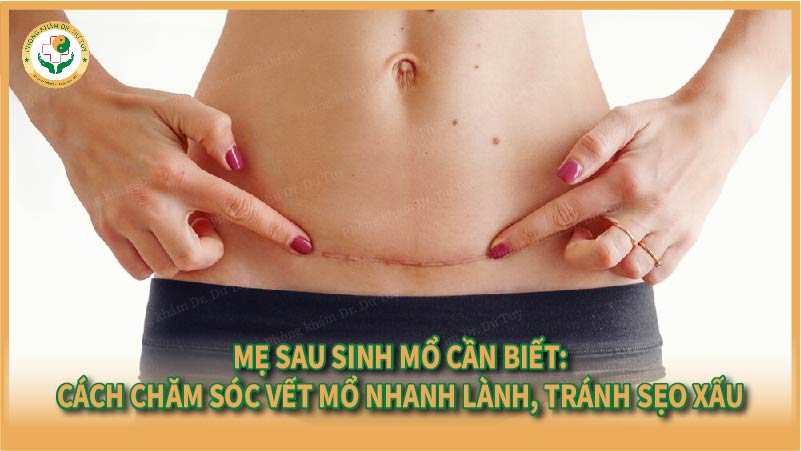 Mẹ sau sinh mổ cần biết: Cách chăm sóc vết mổ nhanh lành, tránh sẹo xấu