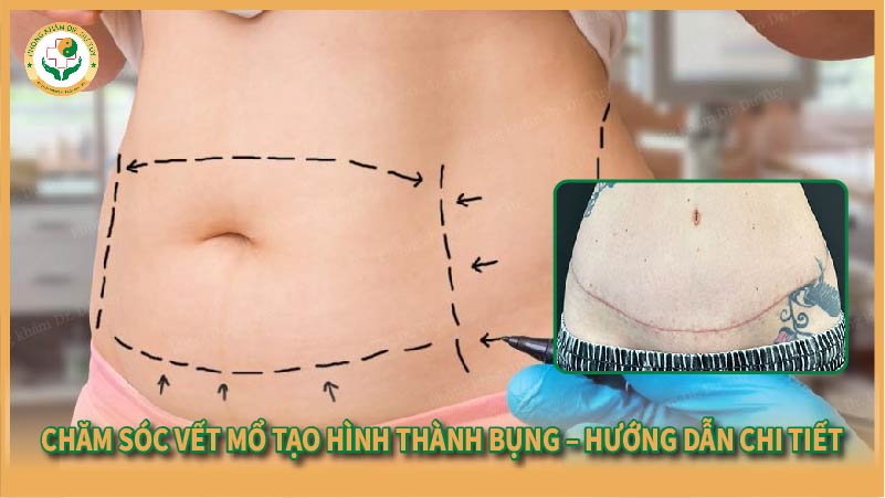 Chăm sóc vết mổ tạo hình thành bụng – Hướng dẫn chi tiết