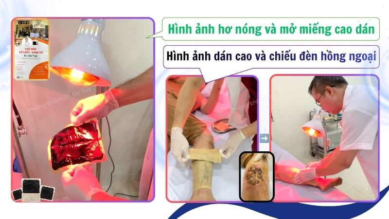 chăm sóc vết thương bằng cao dán Dr. Dư Tuy