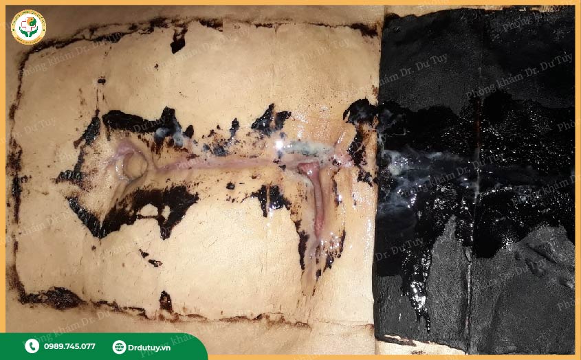 chăm sóc vết thương sau mổ