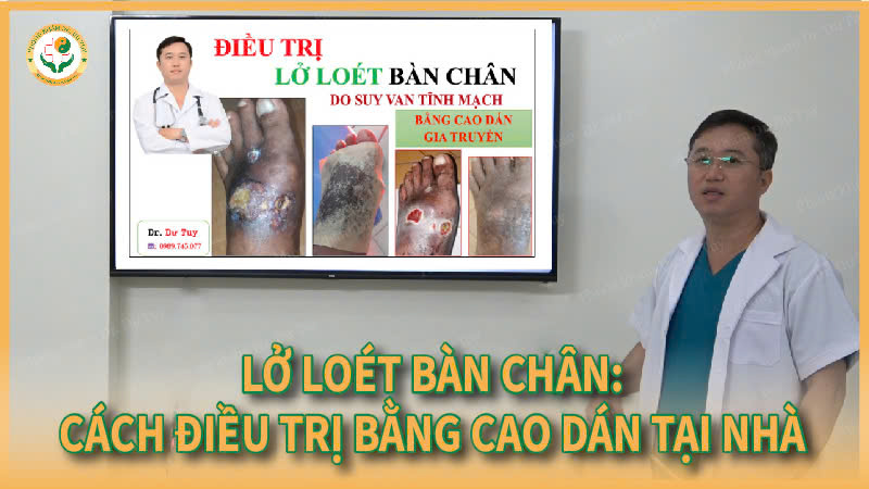 Lở loét chân do suy van tĩnh mạch: Nguyên nhân và cơ chế phát triển