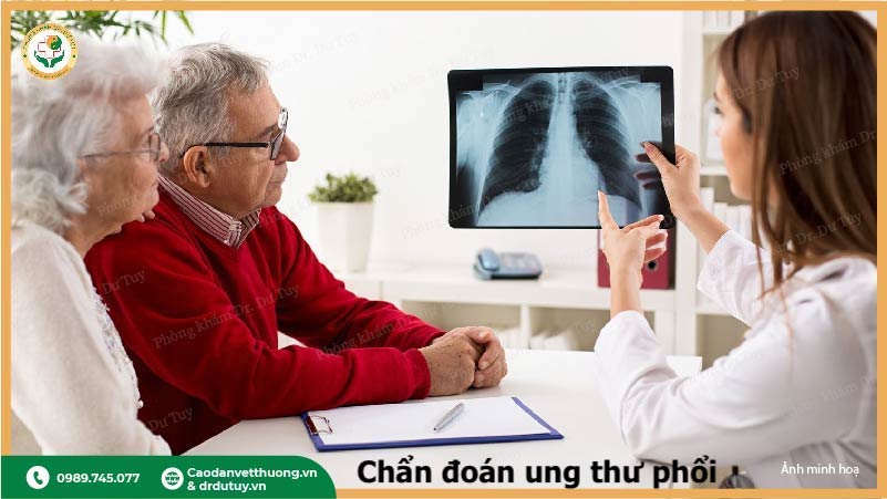 chẩn đoán ung thư phổi chụp xquang