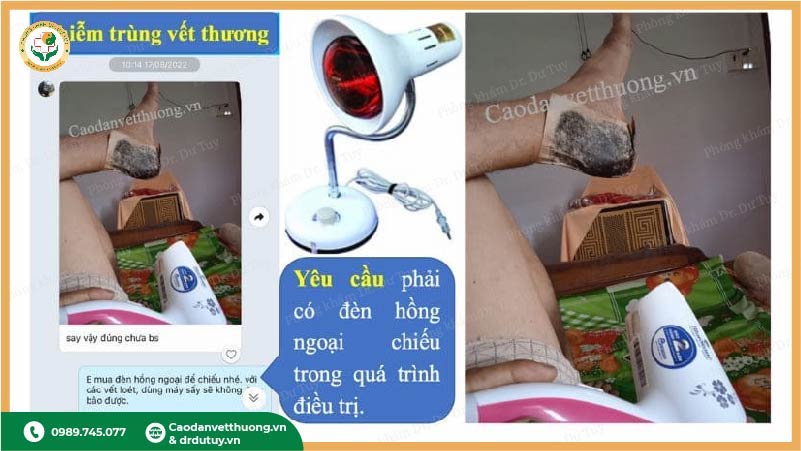 chiếu đèn hồng ngoại hỗ trợ điều trị vết thương