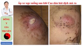 Chữa áp xe da không cần chích rạch bằng cao dán Đông y