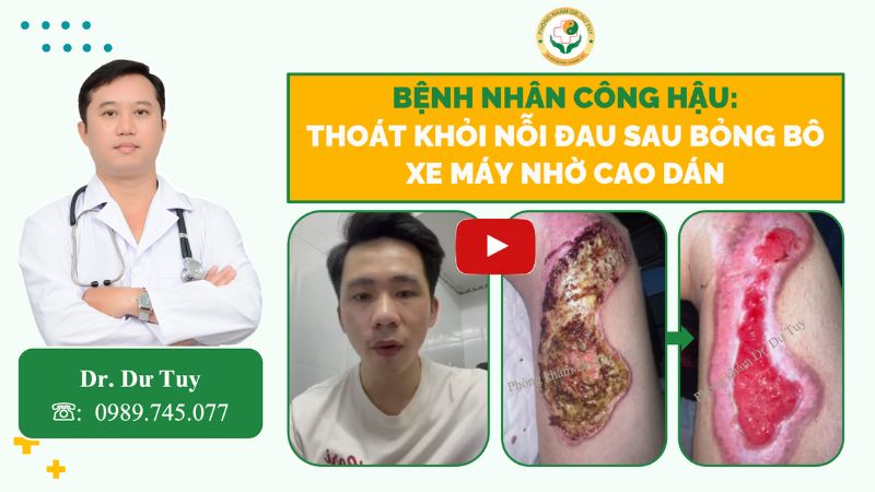 chữa bỏng bô xe máy tại nhà