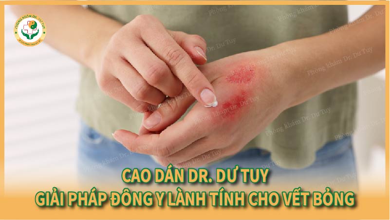 Cao dán Dr. Dư Tuy – Giải pháp Đông y lành tính cho vết bỏng